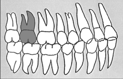 Zahn-Körper-Beziehungen Zahn 17
