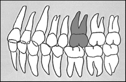 Zahn-Körper-Beziehungen Zahn 26