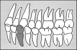 Zahn-Körper-Beziehungen Zahn 33
