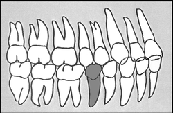 Zahn-Körper-Beziehungen Zahn 45