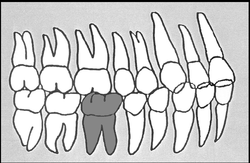 Zahn-Körper-Beziehungen Zahn 46